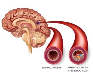 Атеросклероз сосудов головного мозга причины