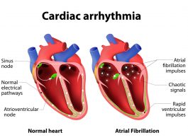 Мерцательная аритмия: лечение