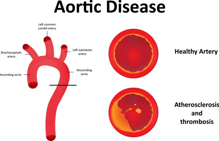 Атеросклероз аорты клапанов сердца
