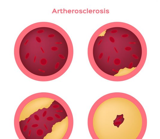 Атеросклероз сосудов головного мозга: лечение и профилактика