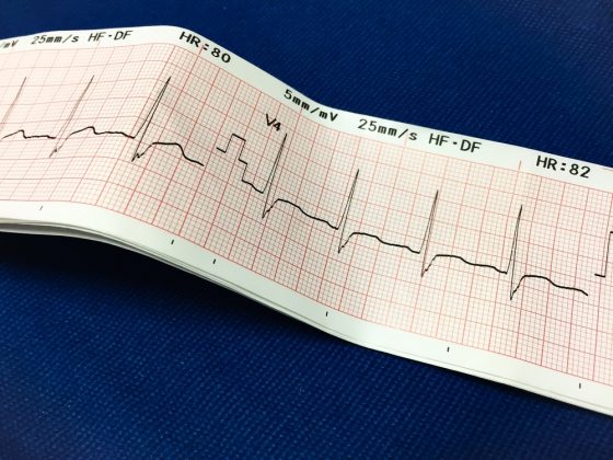 Расшифровка кардиограммы сердца по фото