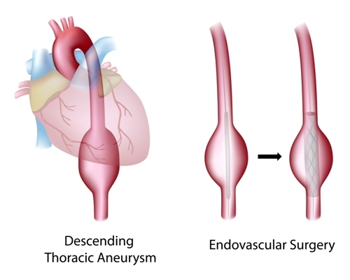 Как вылечить аневризму аорты сердца