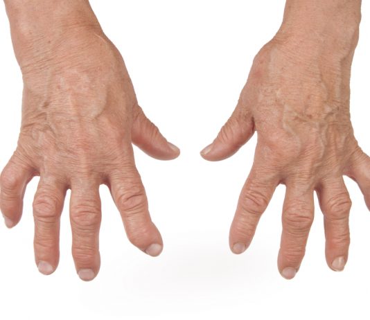 Ревматоидный артрит: причины, механизмы развития, симптомы