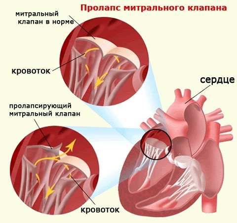 Дегенеративные изменения митрального клапана