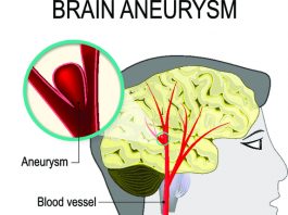 Аневризма сосудов головного мозга: симптомы, принципы лечения