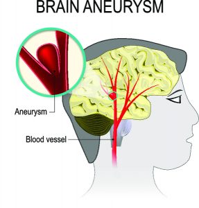 Что такое аневризма головного мозга фото